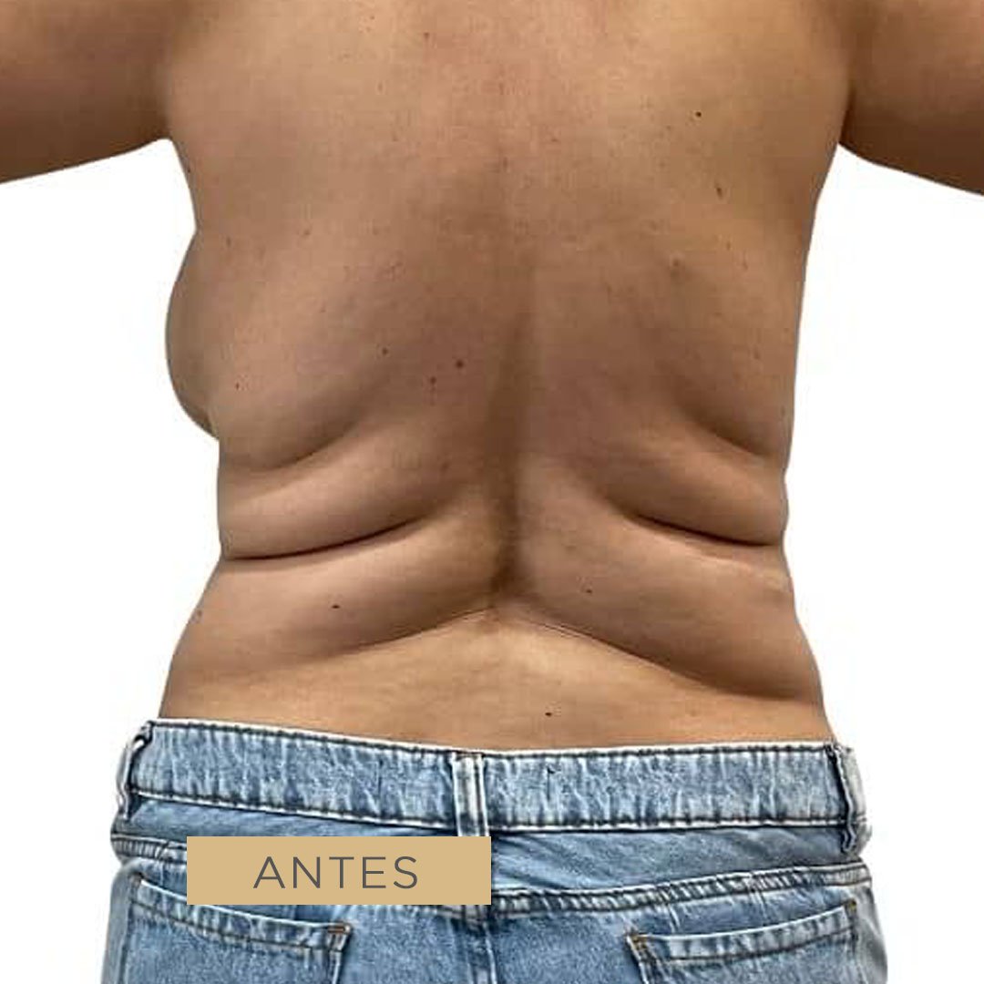 Fotos de liposucción y lipoescultura antes 2