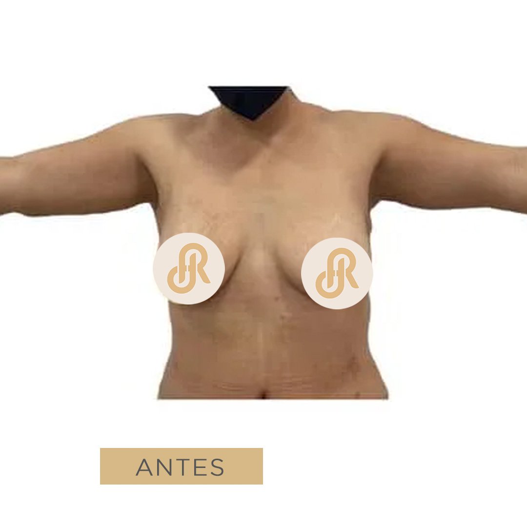 Fotos de braquioplastia despues 1