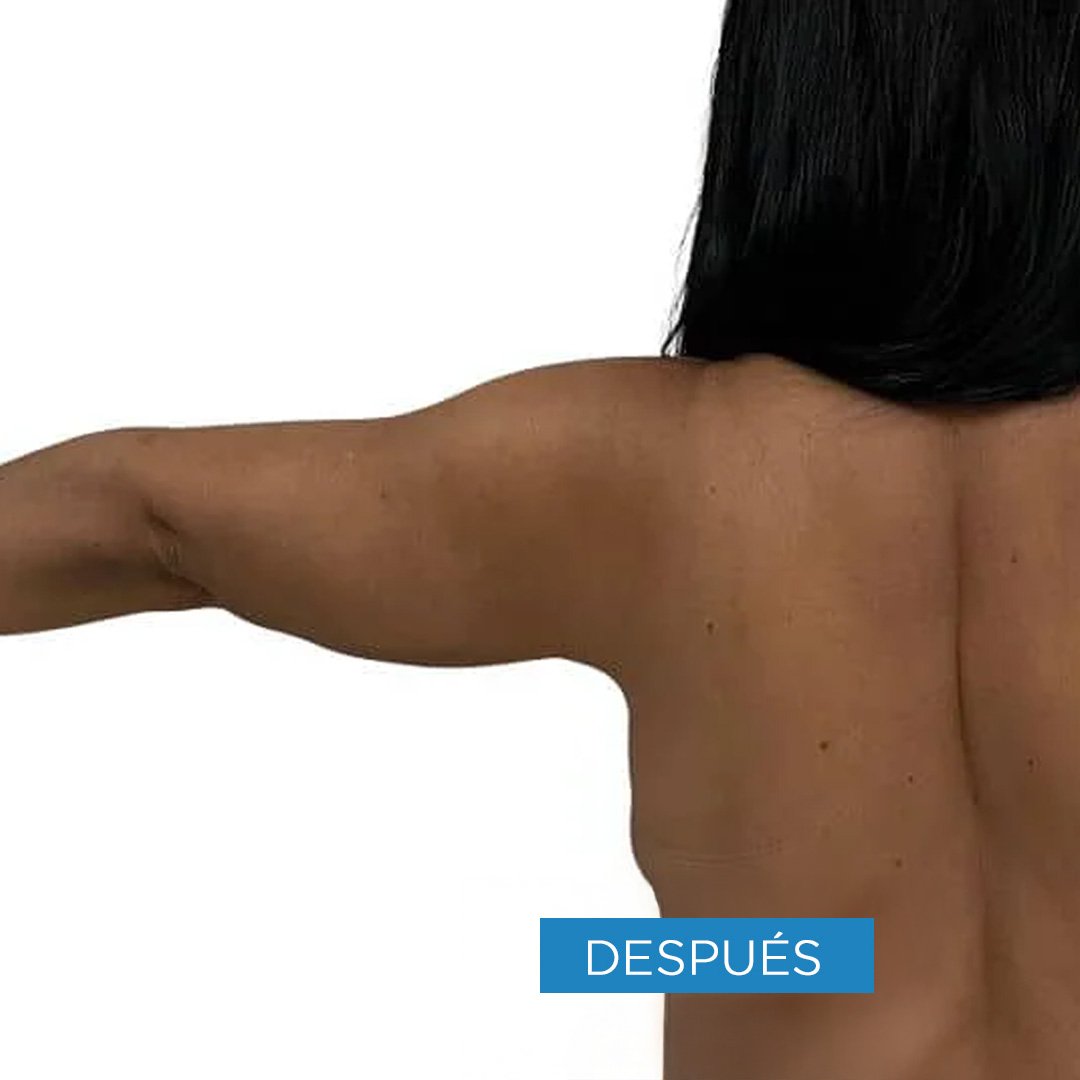 Fotos de braquioplastia despues